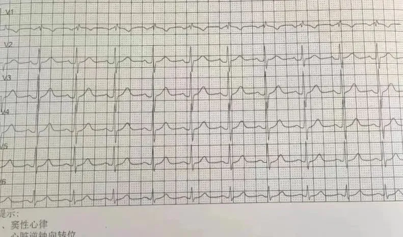 房颤心电图 正常图片